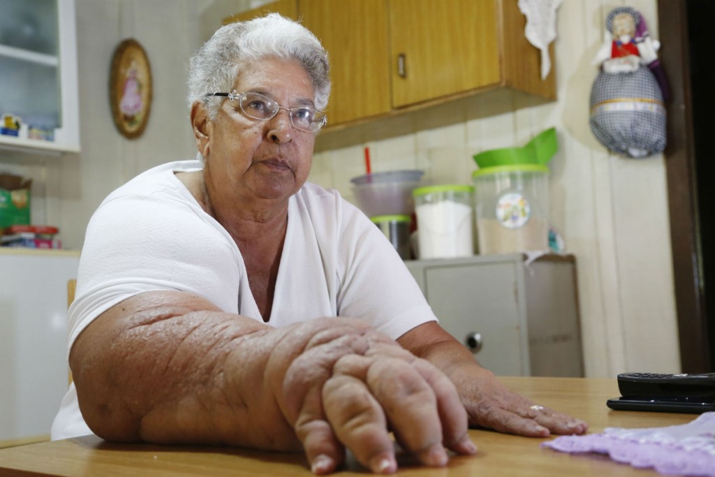Giomar teve o problema no braço após cirurgia. Foto: Felipe Rosa