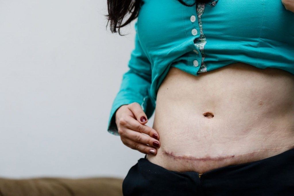 Paula Bibiana Fróes teve um problema raro após realizar uma abdominoplastia. Foto: Marco Charneski