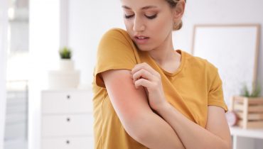 Você sabe qual a diferença entre urticária, alergia e dermatite?