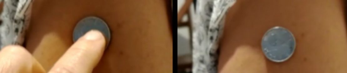 moeda braço vacina covid-19