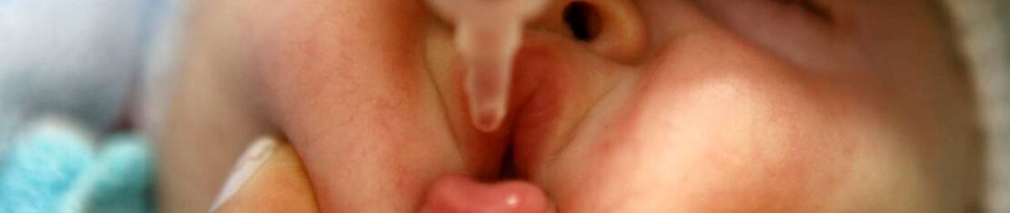 Gotinhas contra a poliomielite.