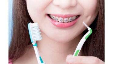 Como escovar os dentes com aparelho?