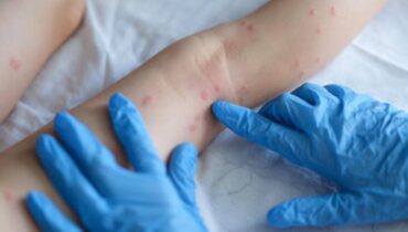 Paraná confirma mais casos de Varíola dos Macacos; Já são 10.