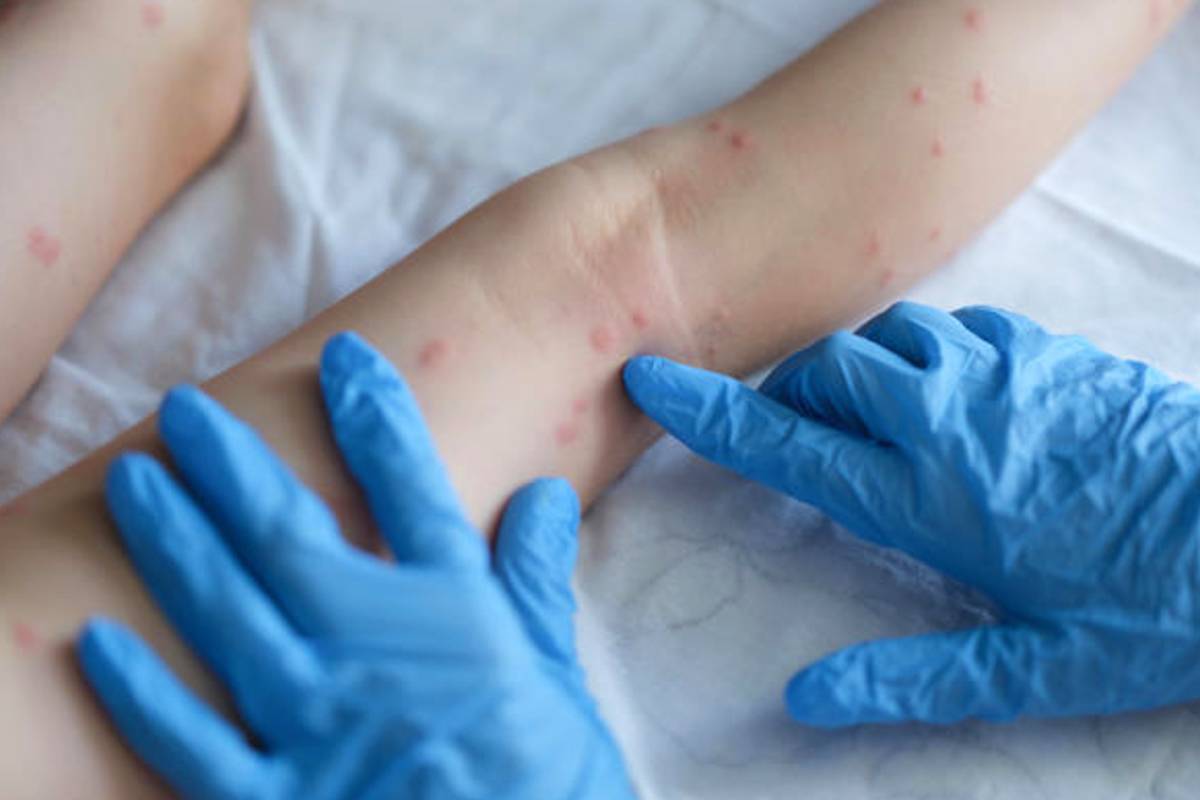 Paraná confirma mais casos de Varíola dos Macacos; Já são 10.