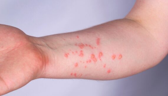 Lesões na pele monkeypox