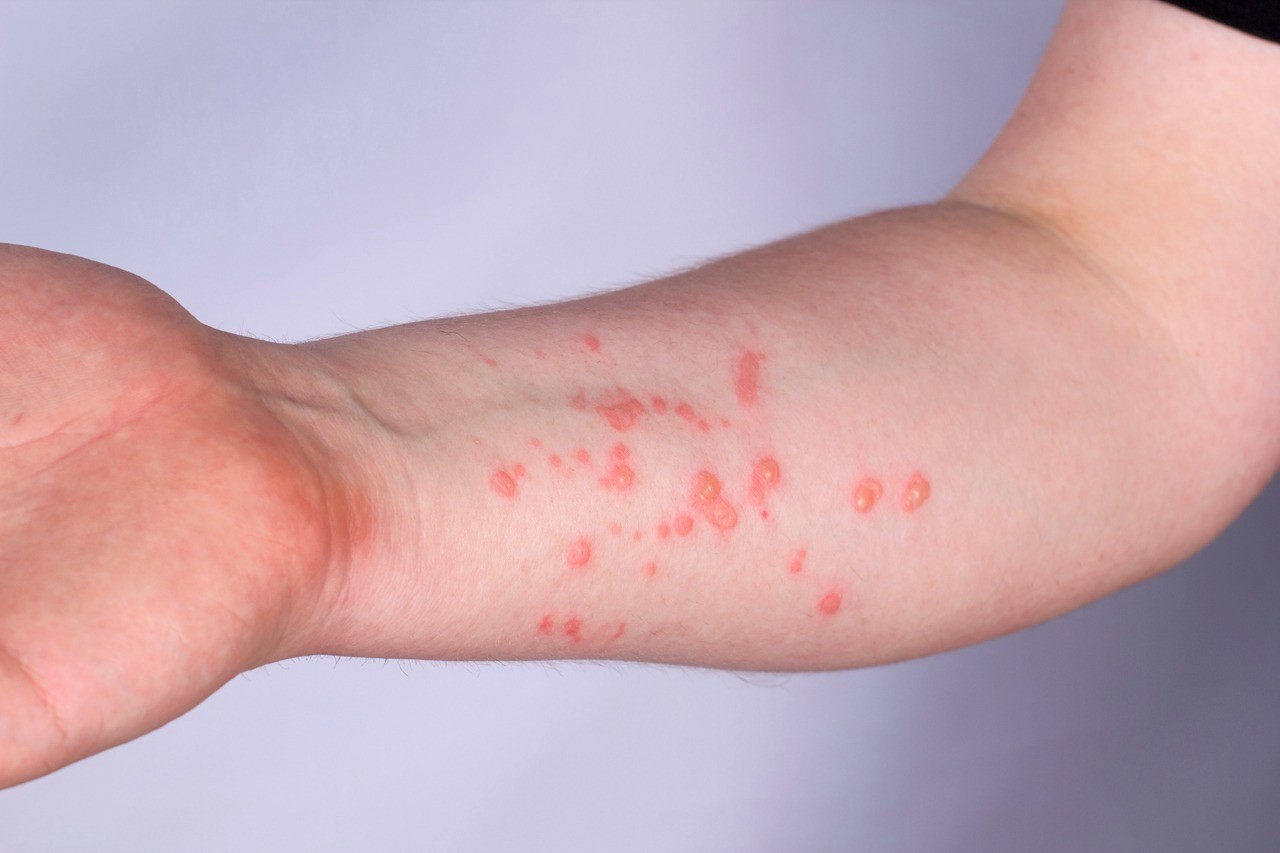 Lesões na pele monkeypox