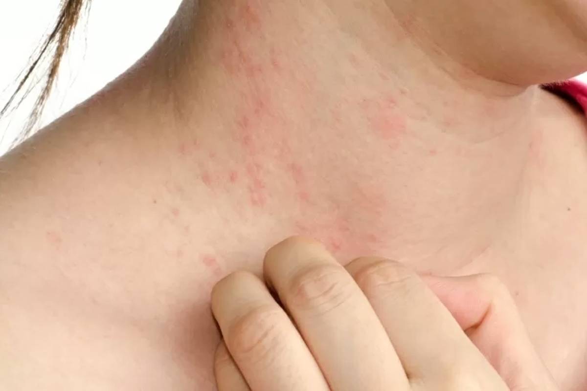 Varíola dos macacos: Como diferenciar lesões desta doença com as de outras?