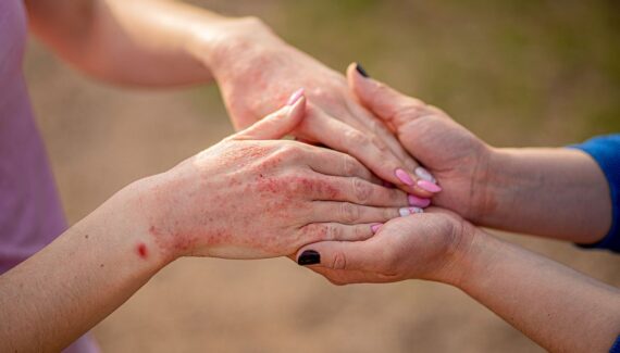 Imagem mostra duas pessoas de mãos dadas, sendo que uma tem manchas vermelhas na pele