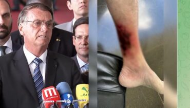 bolsonaro ferida perna
