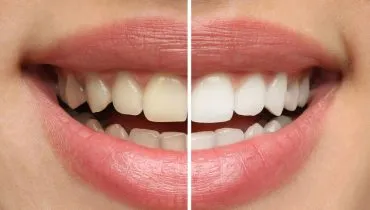 Clareamento dental caseiro: 3 bons motivos para NÃO fazer