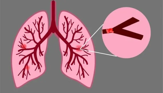 Embolia pulmonar: conheça os sintomas e os fatores de risco da doença