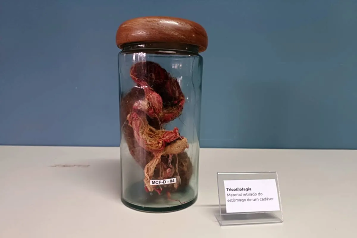 Estômago de um indivíduo com tricofagia, doença em que a pessoa engole o próprio cabelo,