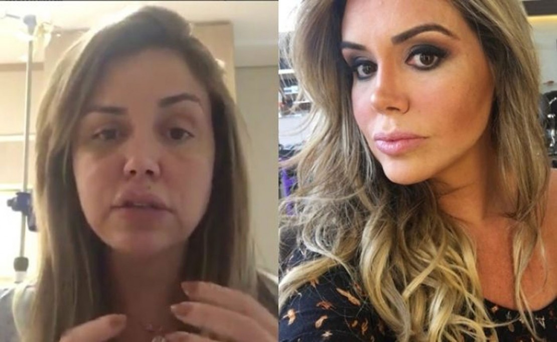 Renata Banhara passa por nova cirurgia e tem pedaço do osso craniano retirado