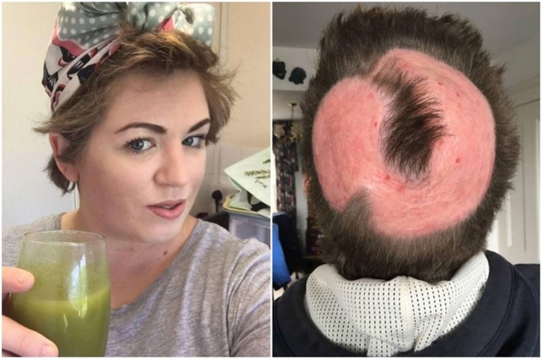 Mulher sofre queimaduras graves após usar pó descolorante no cabelo