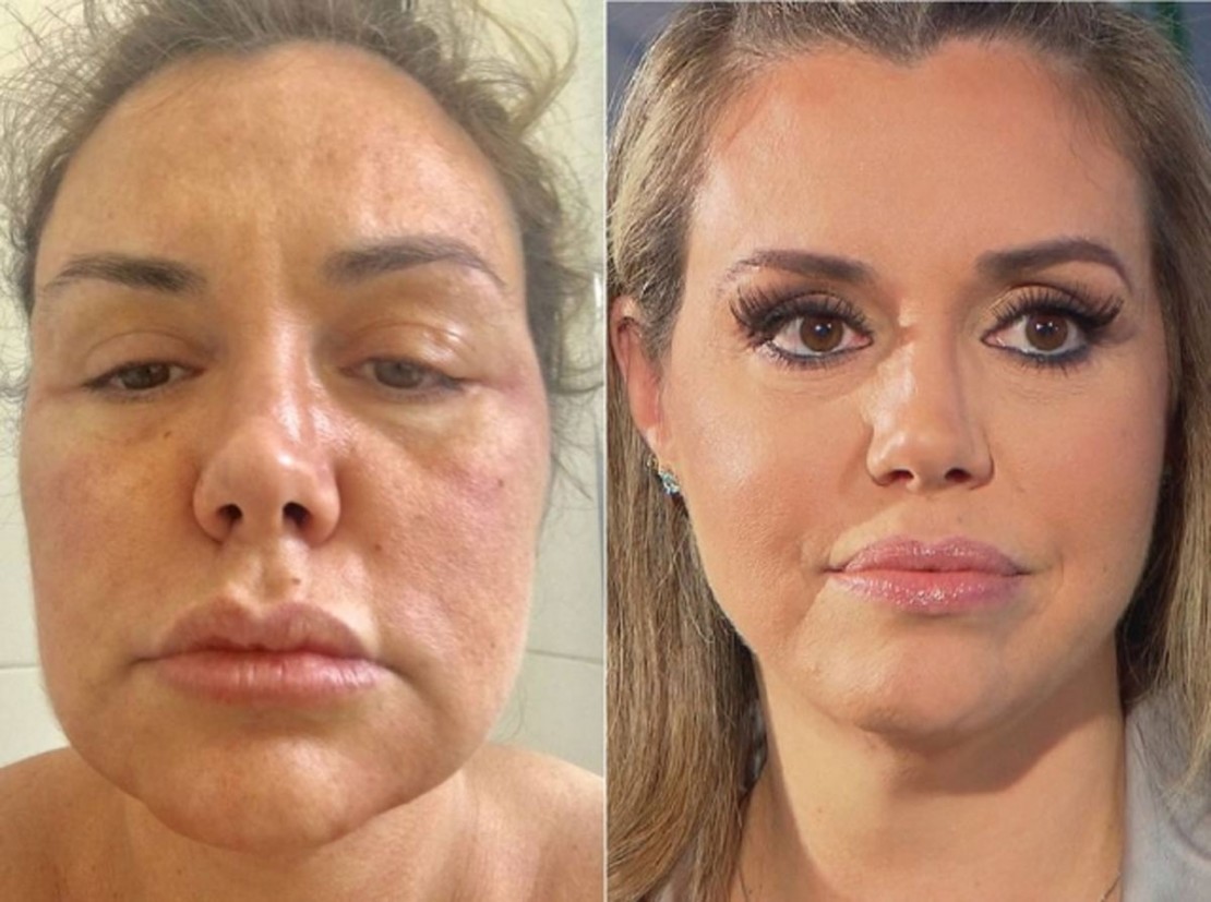 Renata Banhara desabafa sobre paralisia facial: 'estou doente, eu sinto dores'