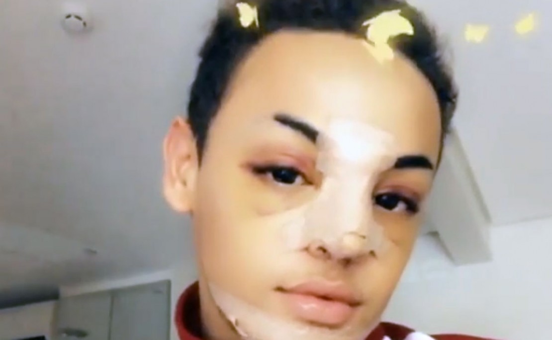 Pabllo Vittar faz cirurgia no nariz e posta pós-cirúrgico nas redes sociais. Foto: Divulgação/Instagram.