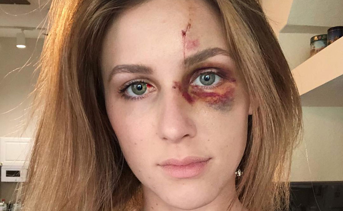 Após ser agredida pelo ex, Melissa fez questão de não esconder as marcas da violência que ficaram em seu rosto. Foto: Reprodução/Instagram.