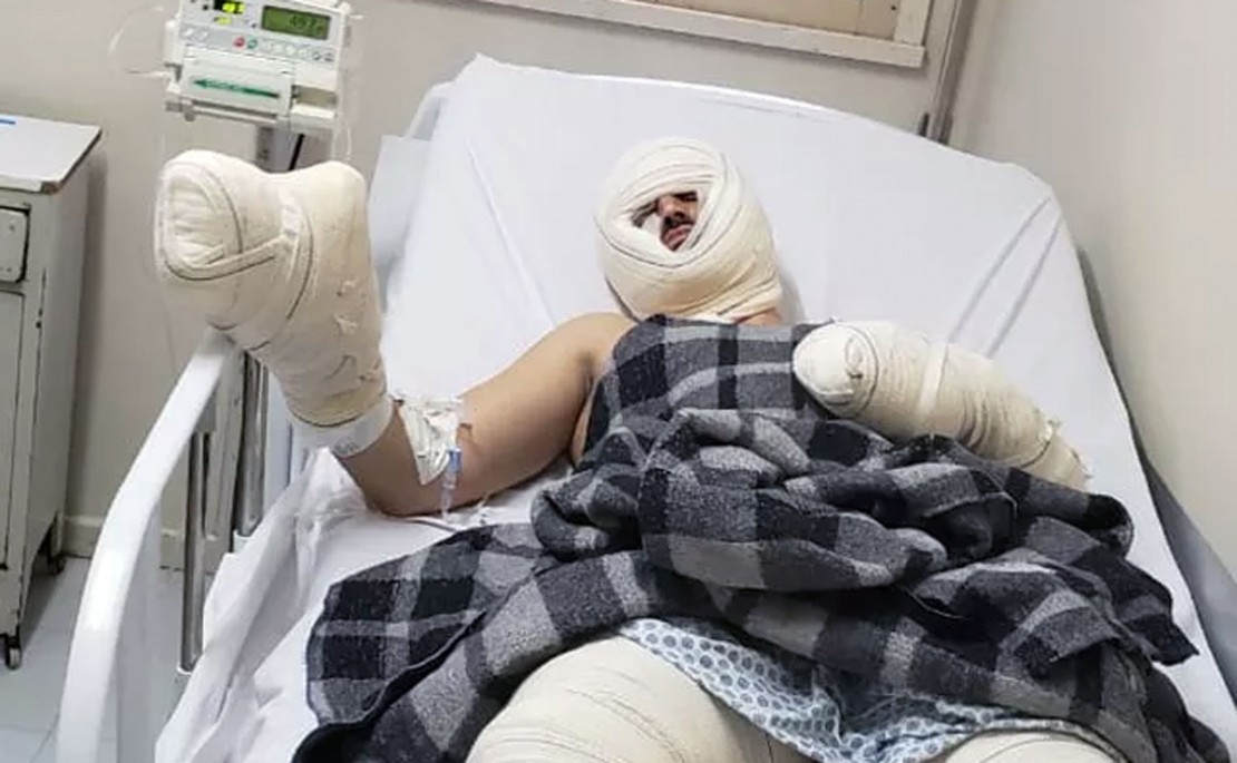 Gabriel Araújo, que tem 27 anos, teve 30% do corpo queimado e já está num quarto do hospital. Foto: Reprodução/RPC.