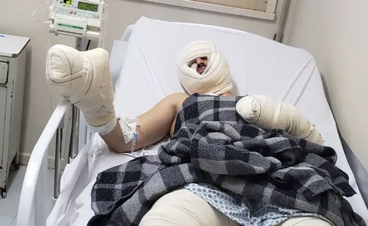 Gabriel Araújo, que tem 27 anos, teve 30% do corpo queimado e já está num quarto do hospital. Foto: Reprodução/RPC.